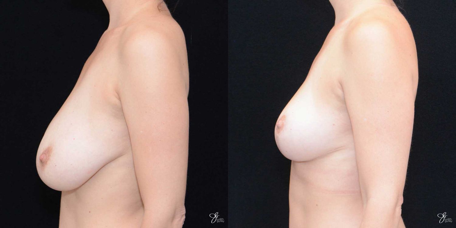 Breast Reduction Before & After