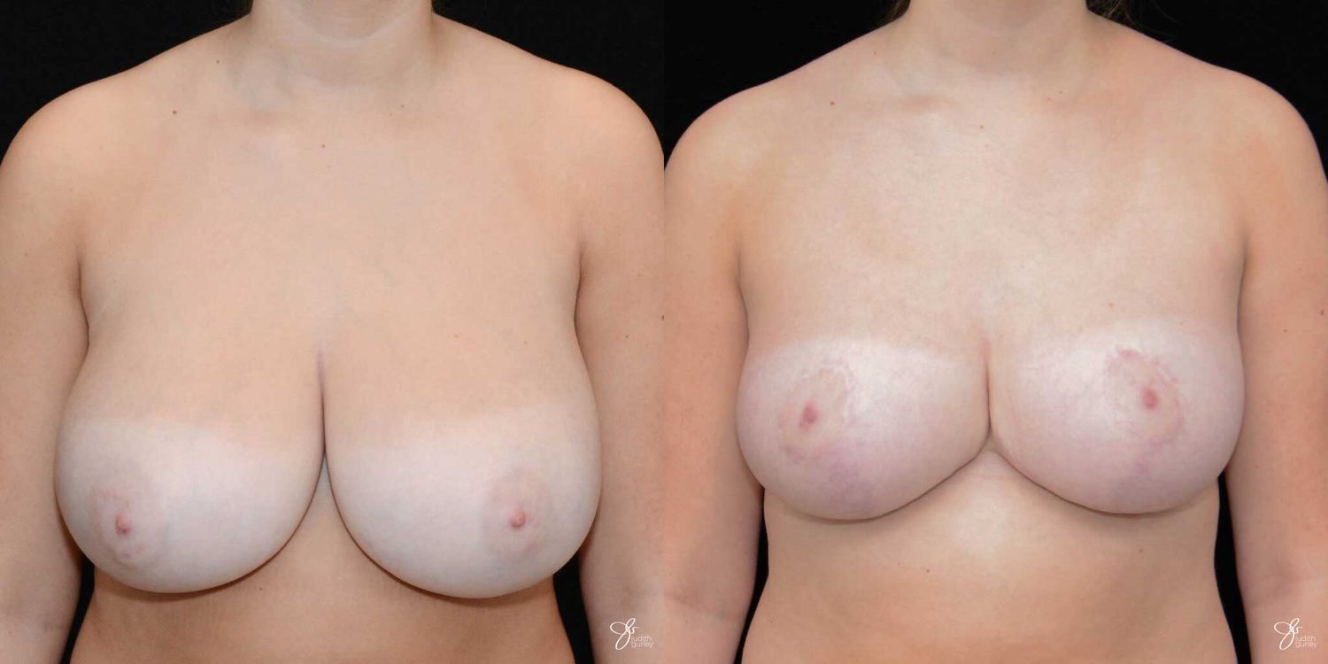 Breast Reduction Before & After