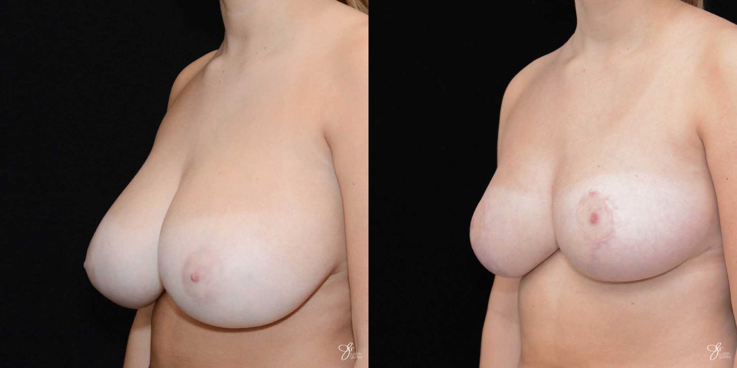 Breast Reduction Before & After