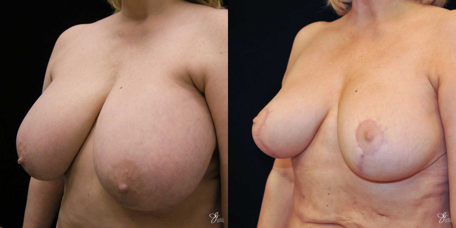 Breast Reduction Before & After