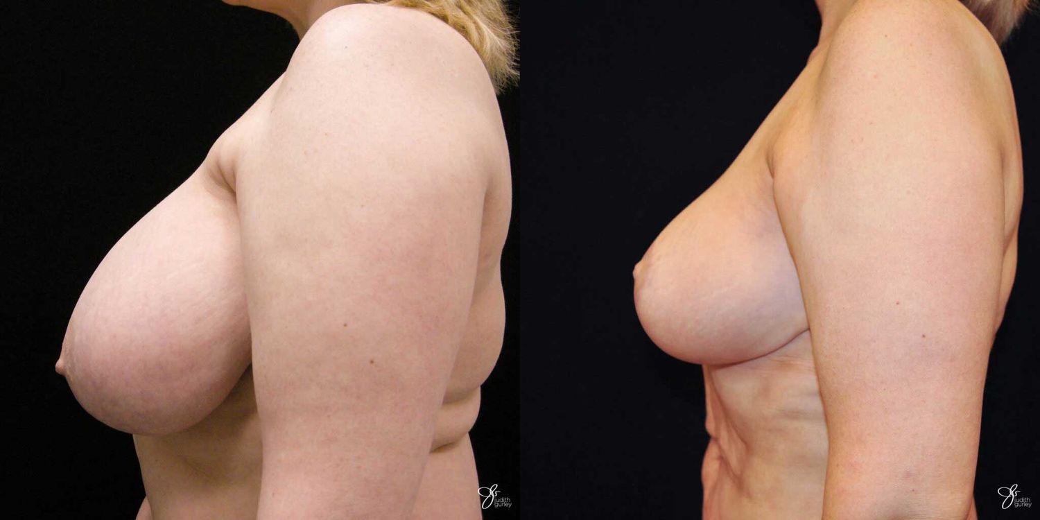 Breast Reduction Before & After