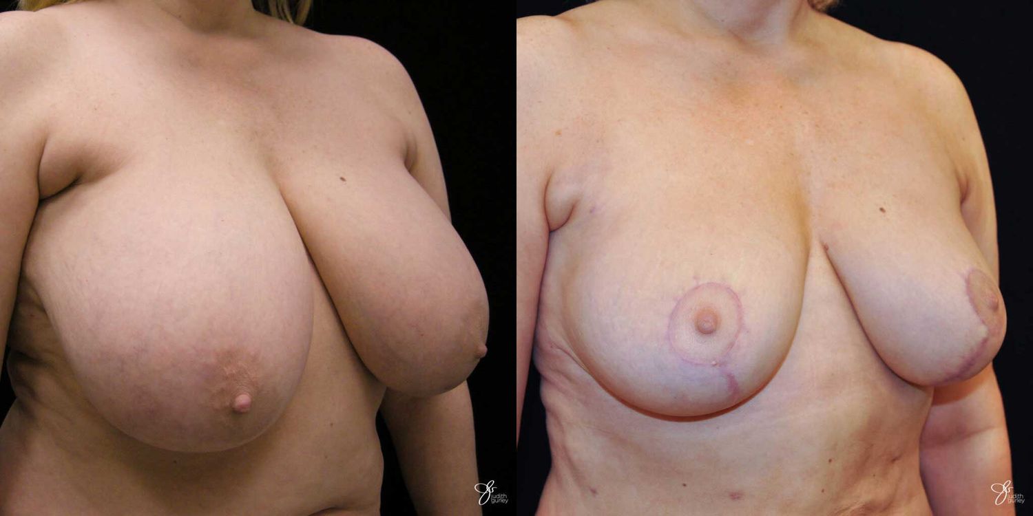 Breast Reduction Before & After