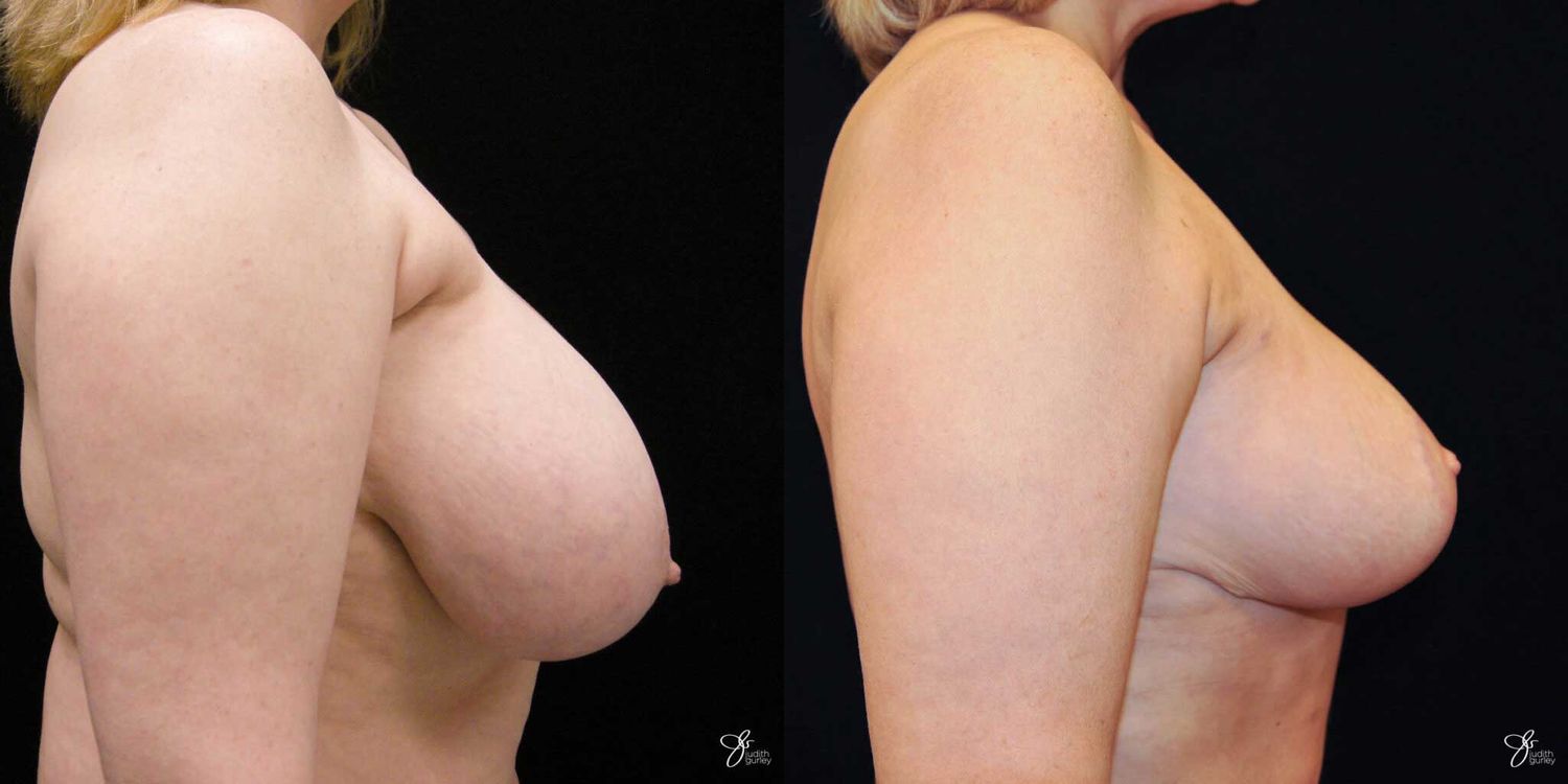 Breast Reduction Before & After
