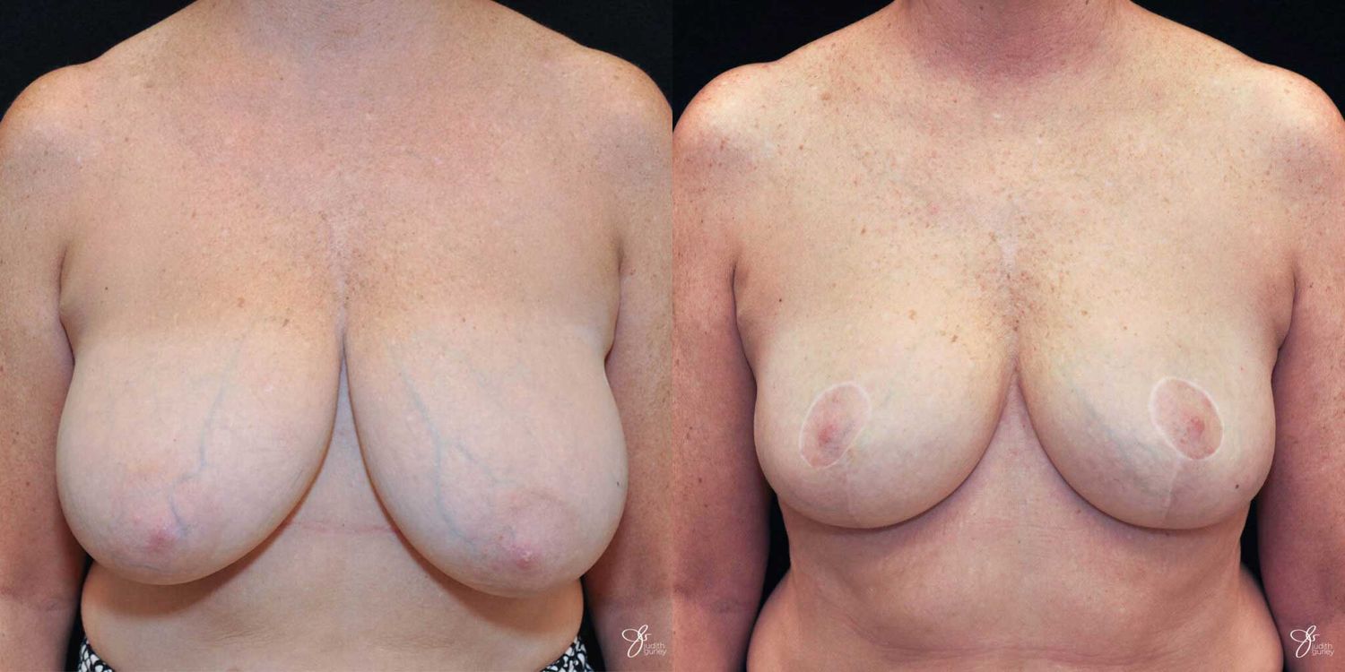 Breast Reduction Before & After