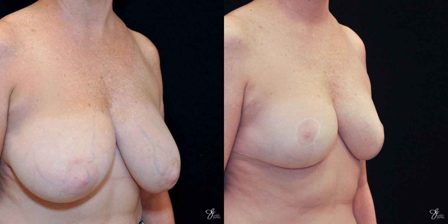 Breast Reduction Before & After