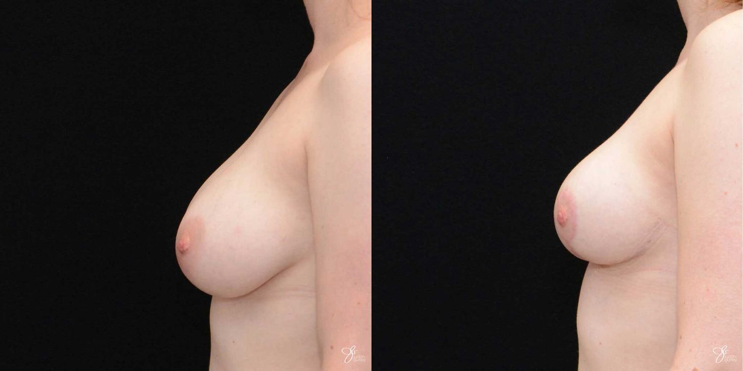 Breast Reduction Before & After