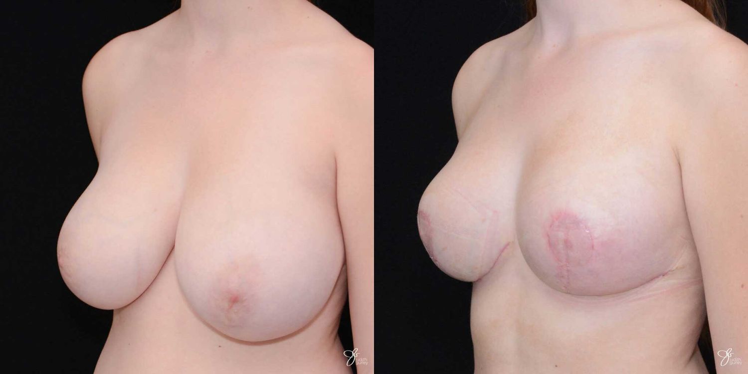 Breast Reduction Before & After
