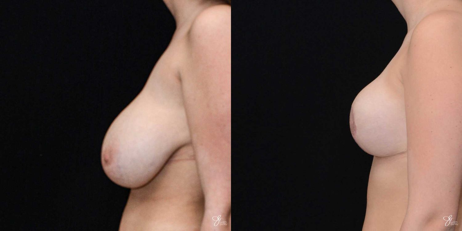 Breast Reduction Before & After