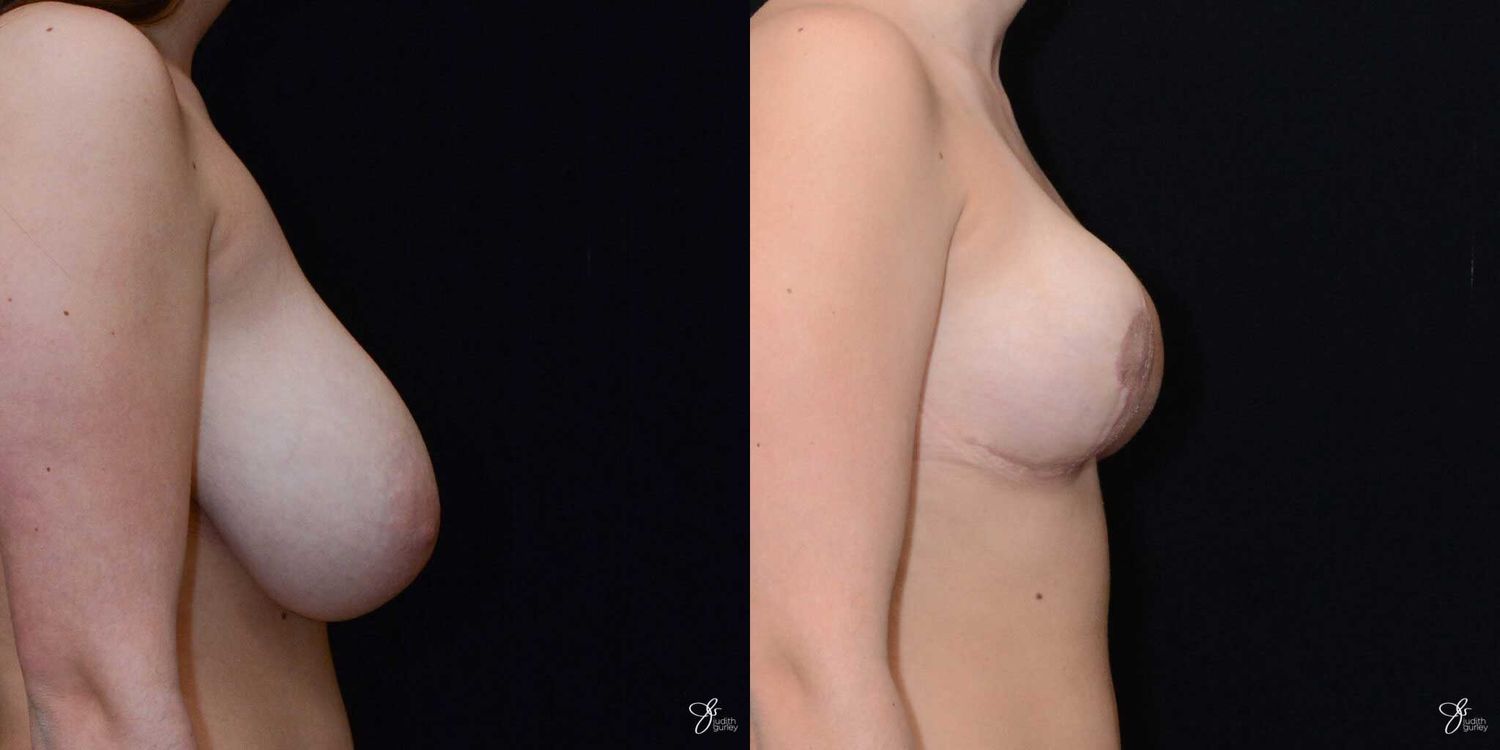 Breast Reduction Before & After