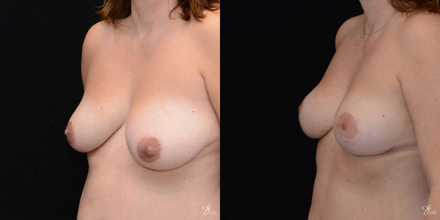 Breast Reduction Before & After