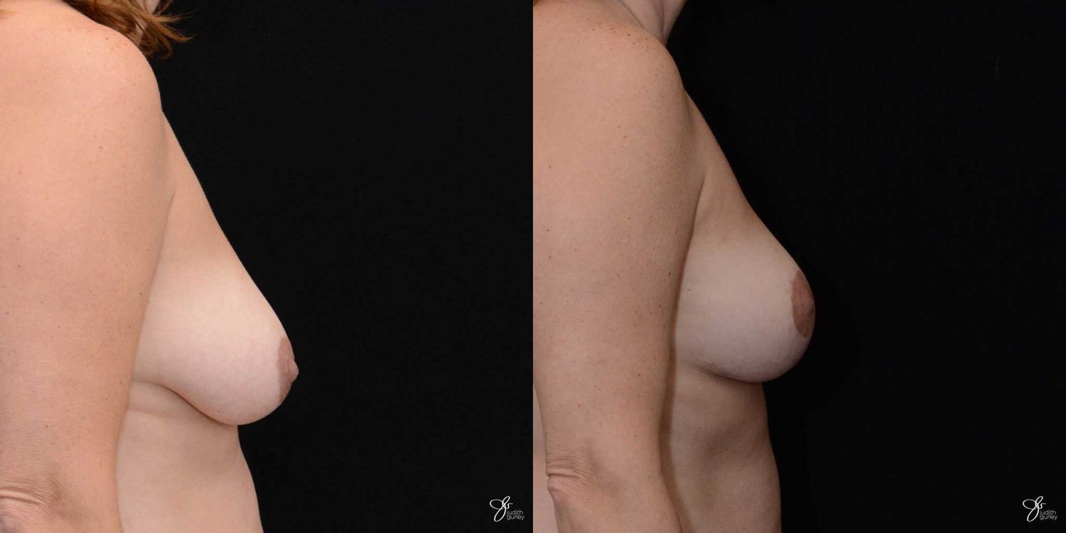 Breast Reduction Before & After