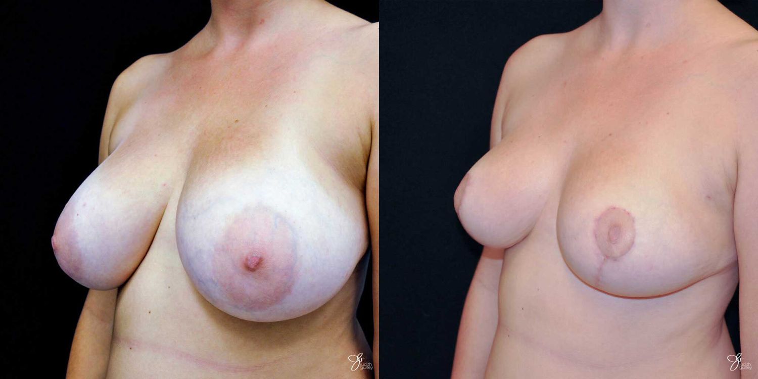 Breast Reduction Before & After