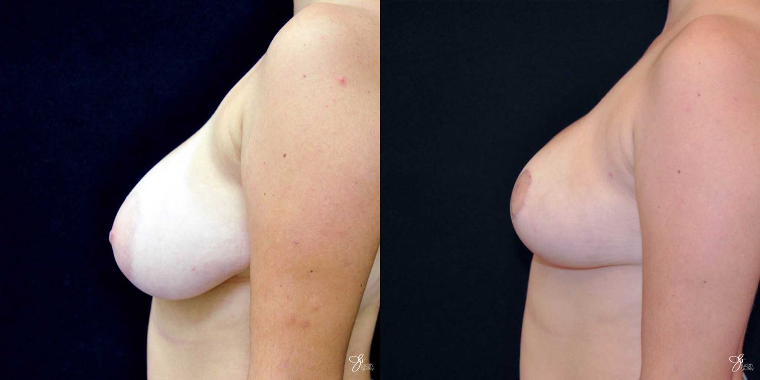 Breast Reduction Before & After