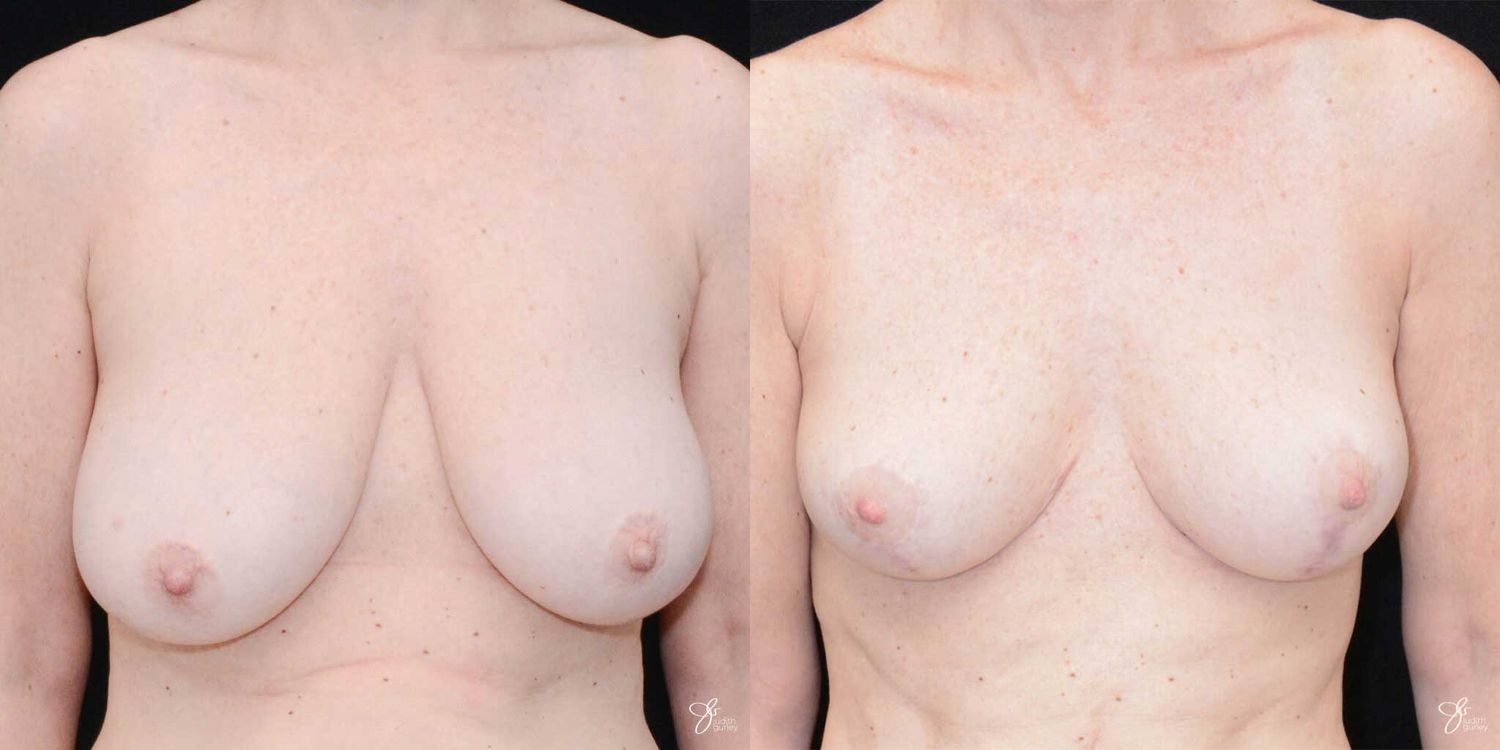 Breast Reduction Before & After
