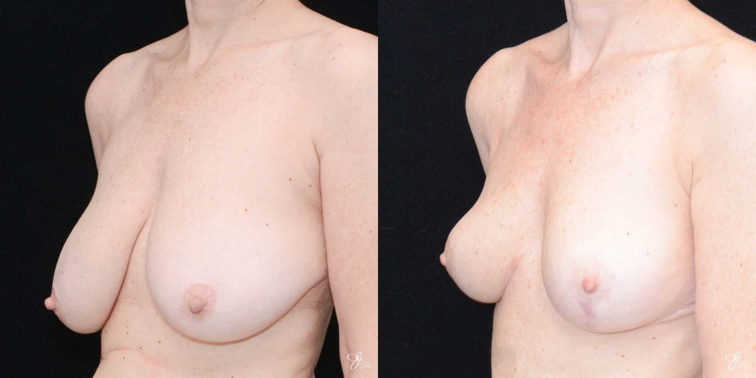 Breast Reduction Before & After