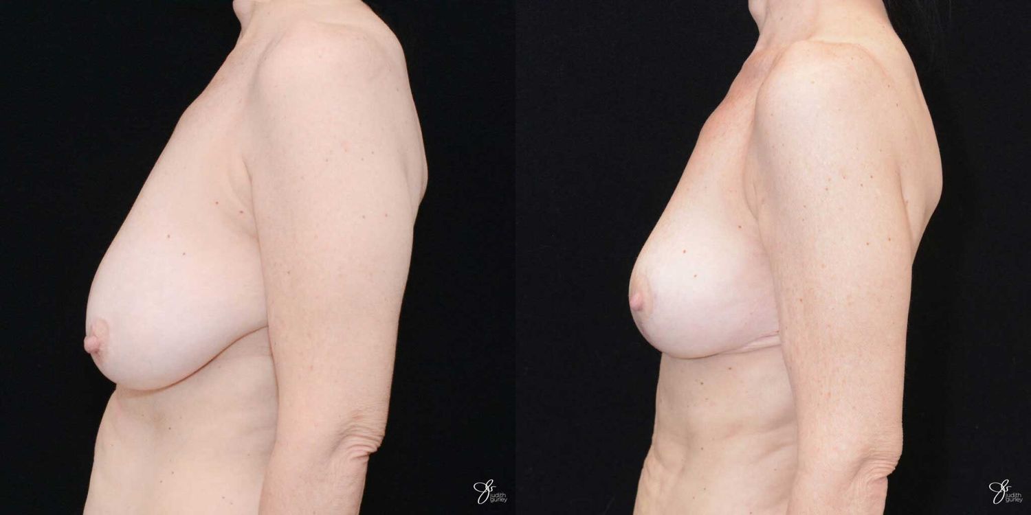 Breast Reduction Before & After