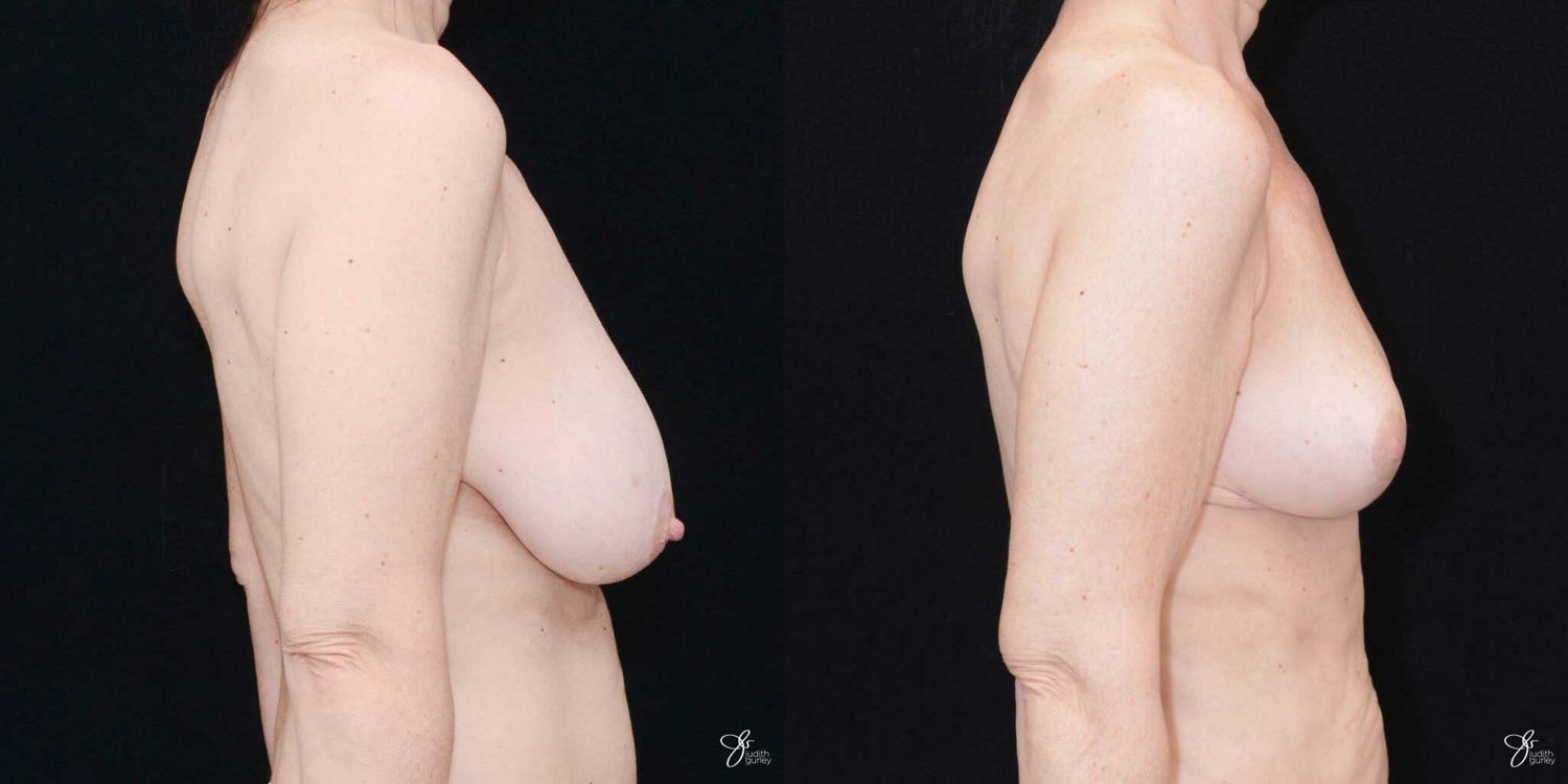 Breast Reduction Before & After