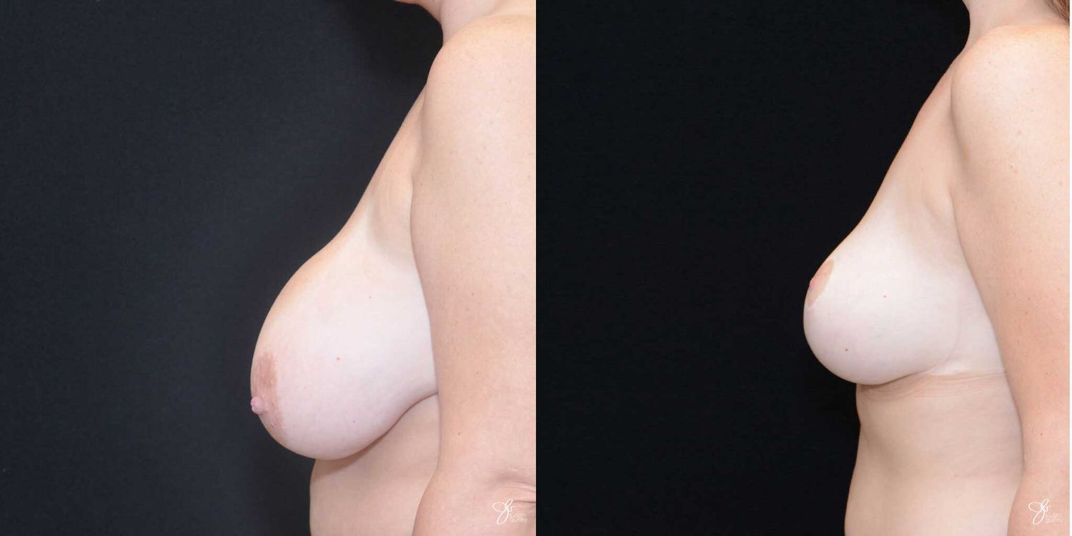 Breast Reduction Before & After
