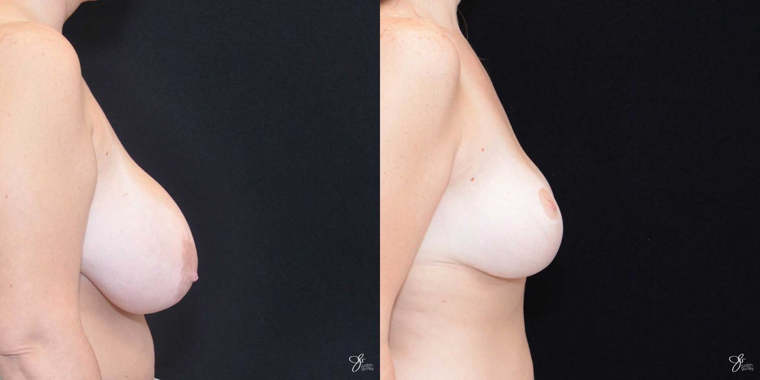 Breast Reduction Before & After