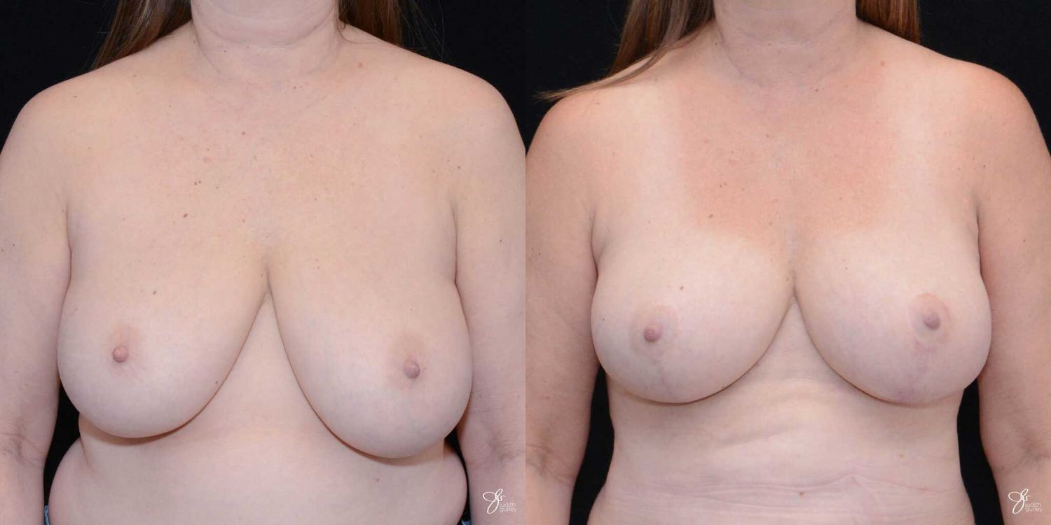 Breast Reduction Before & After