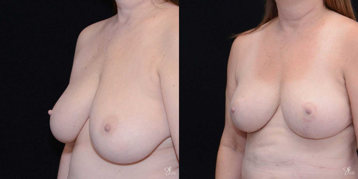 Breast Reduction Before & After