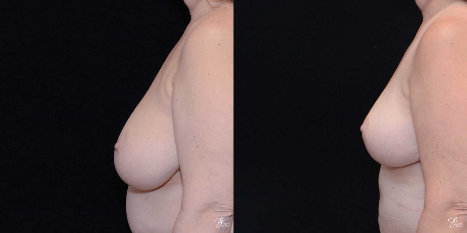Breast Reduction Before & After
