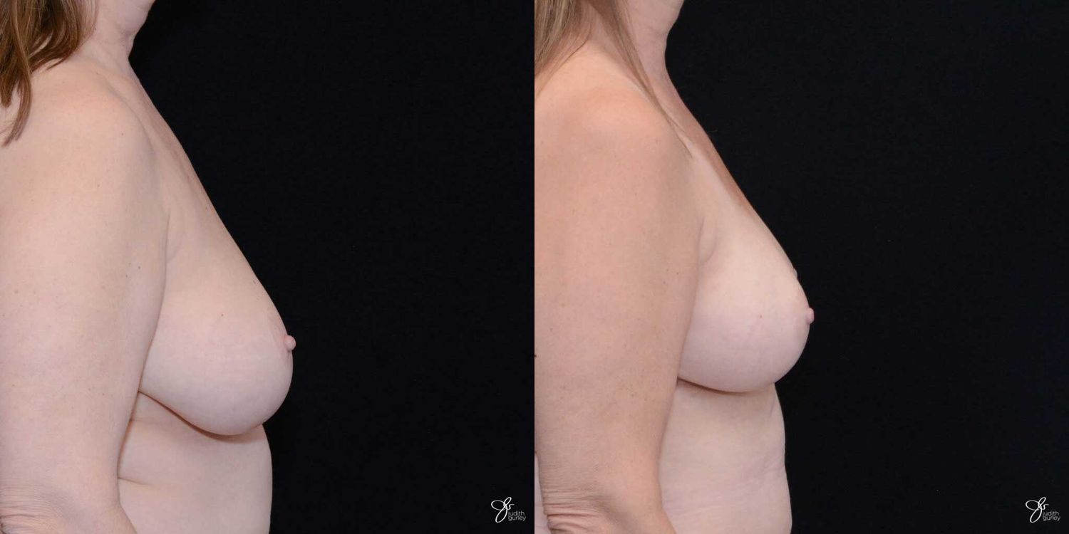 Breast Reduction Before & After