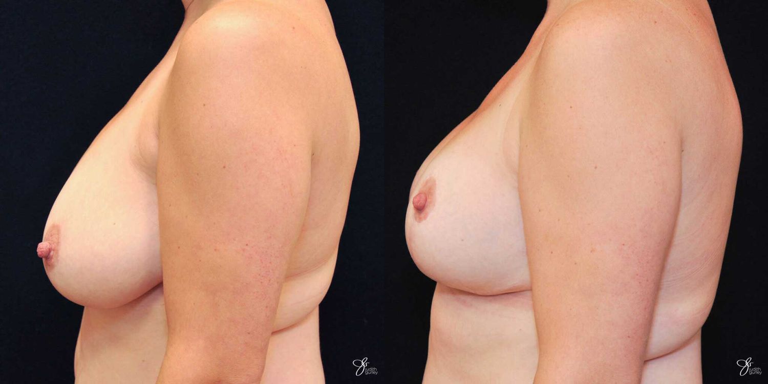 Breast Reduction Before & After