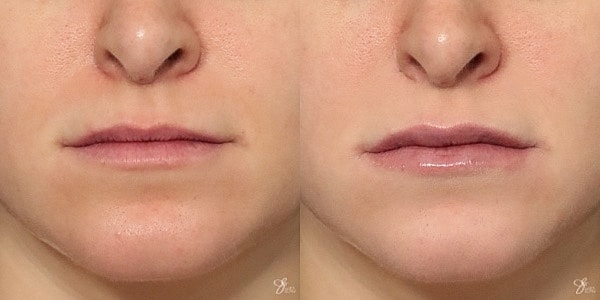 Lip Filler Before & After