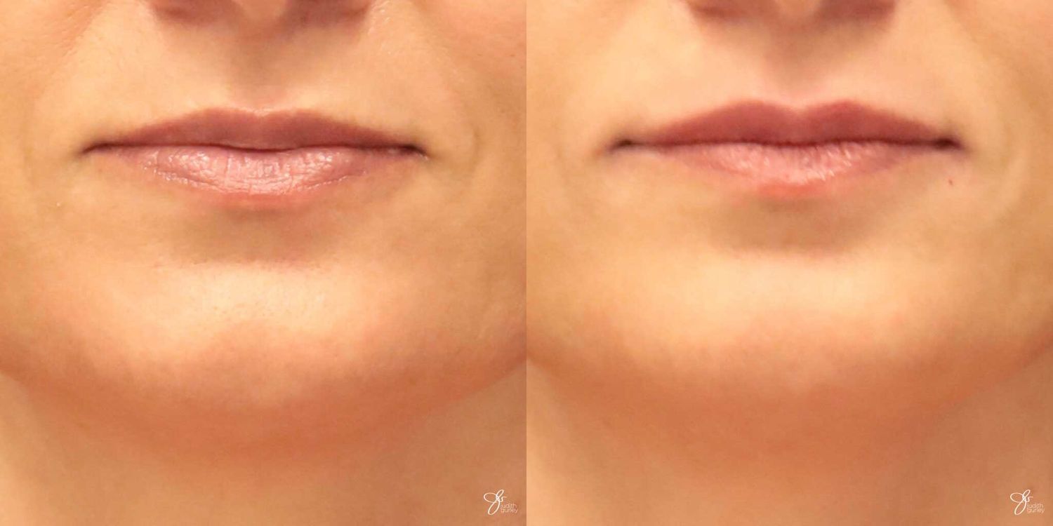 Lip Filler Before & After