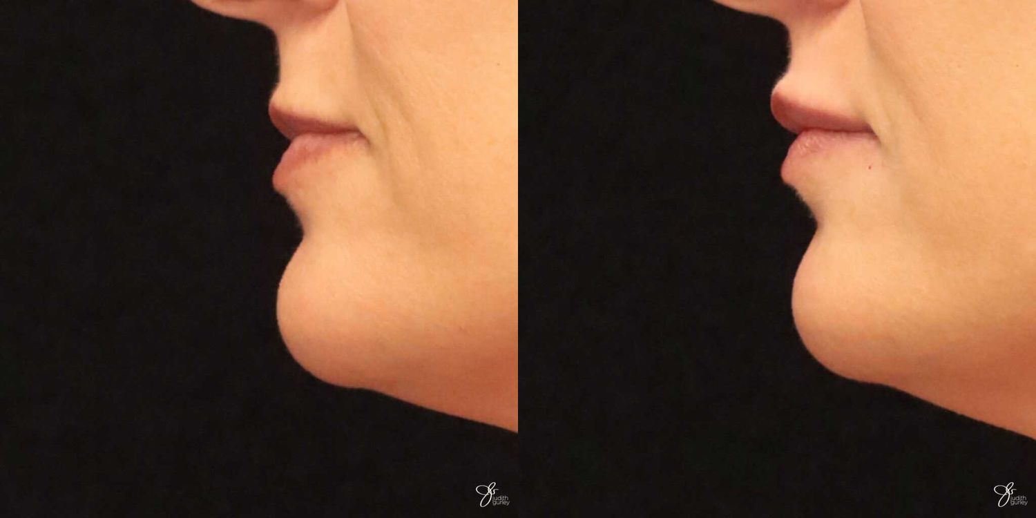 Lip Filler Before & After