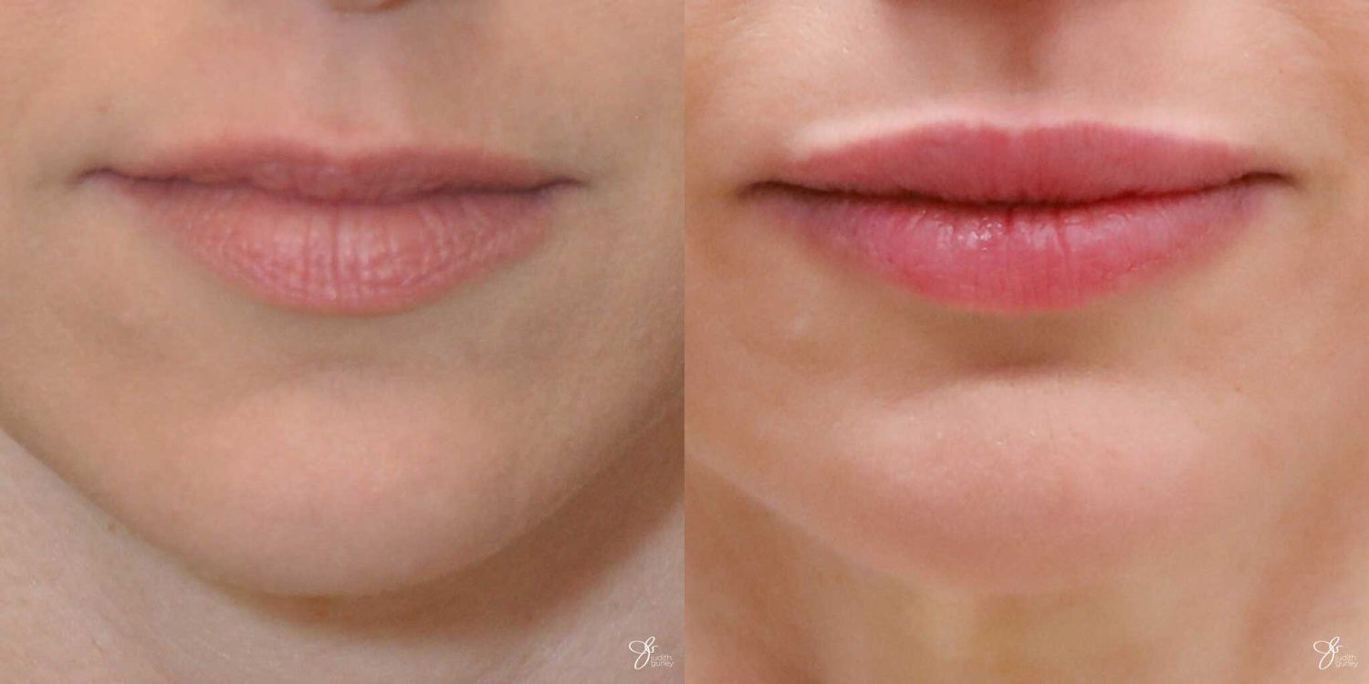 Lip Filler Before & After
