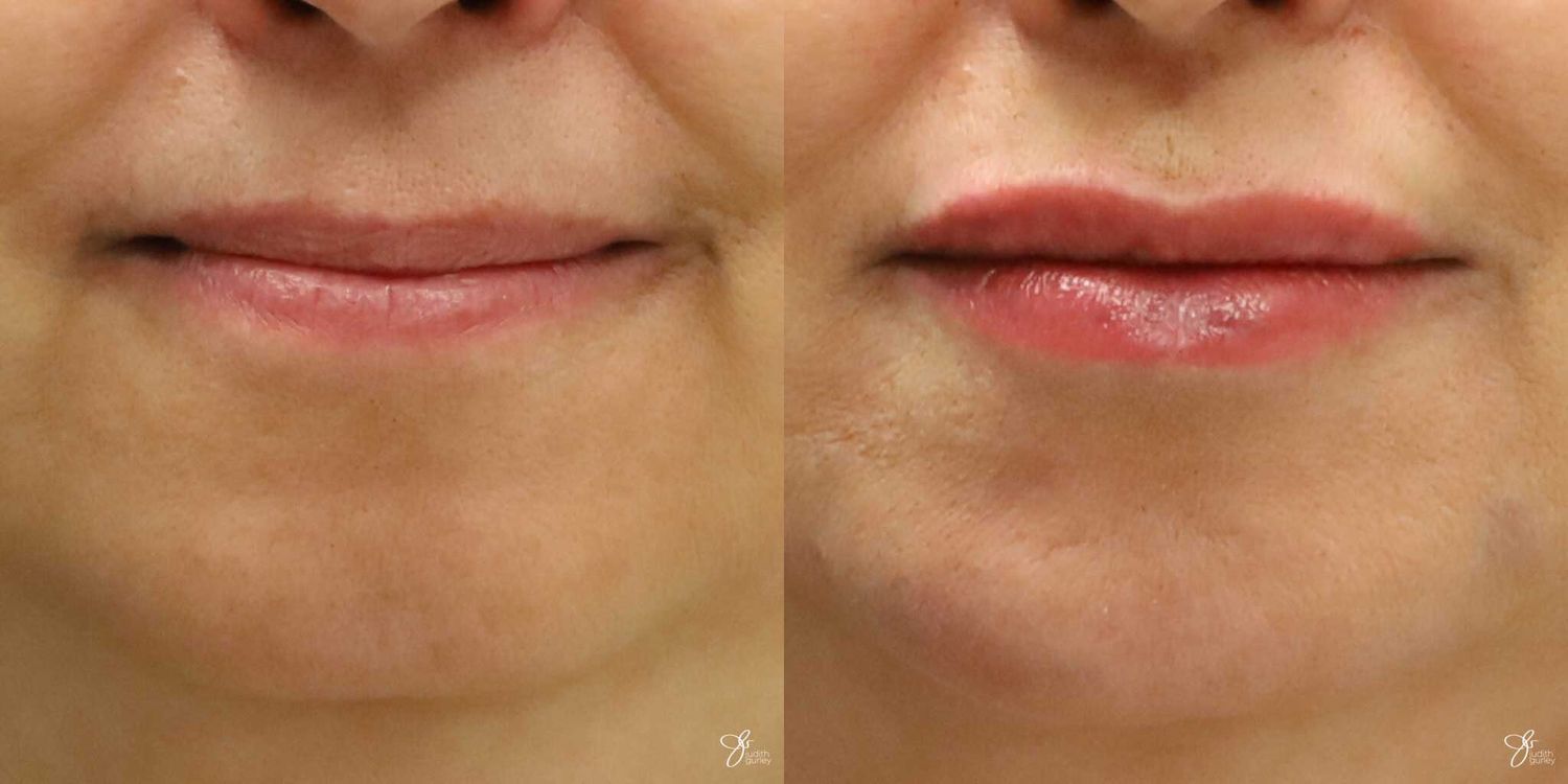 Lip Filler Before & After