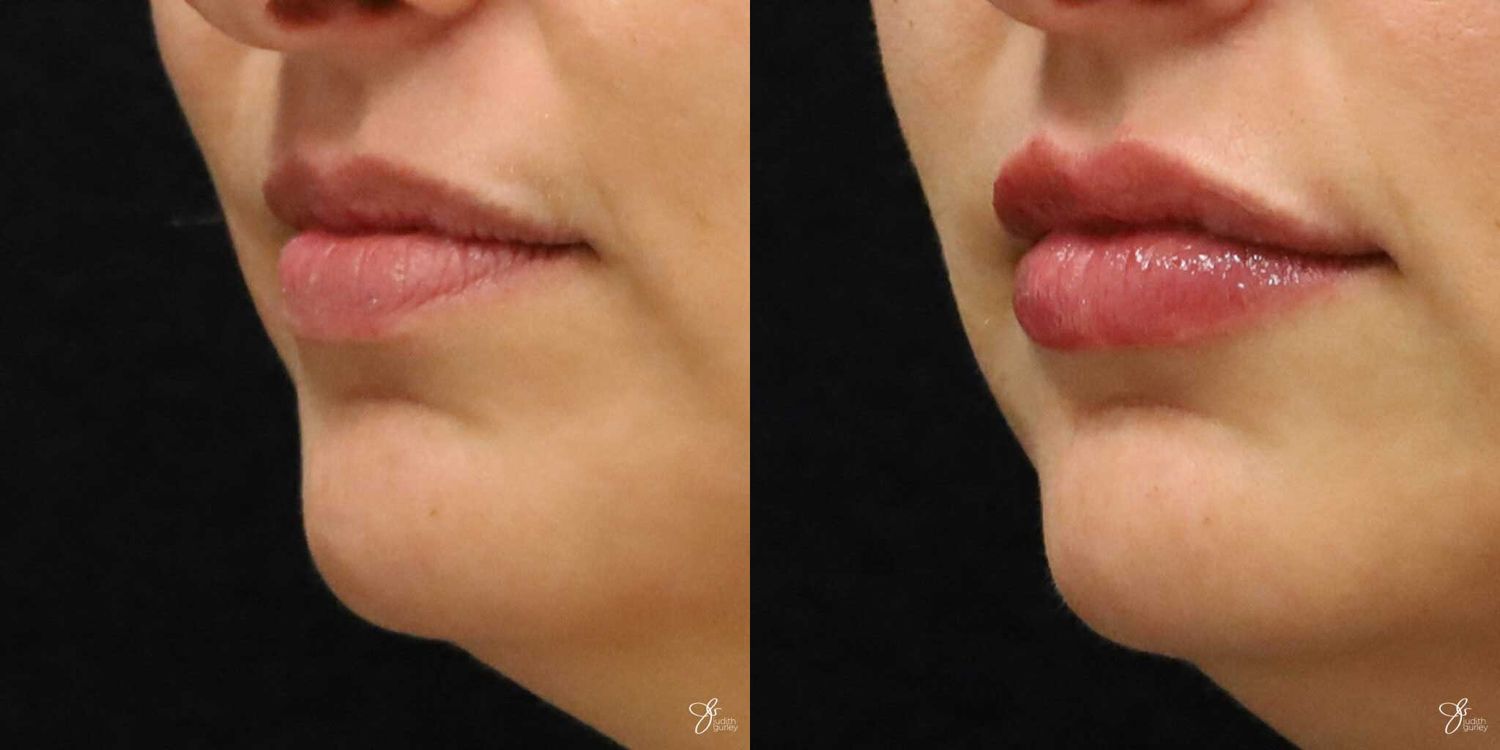 Lip Filler Before & After