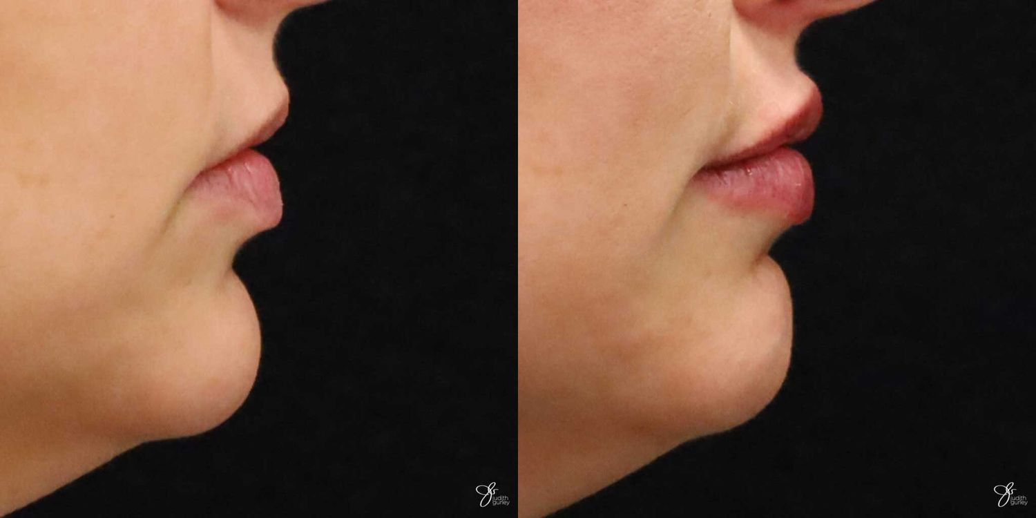 Lip Filler Before & After