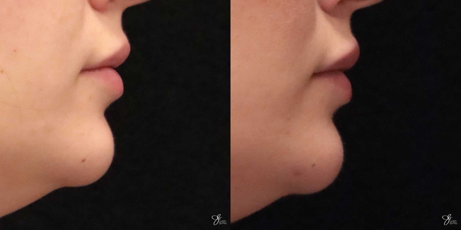 Lip Filler Before & After
