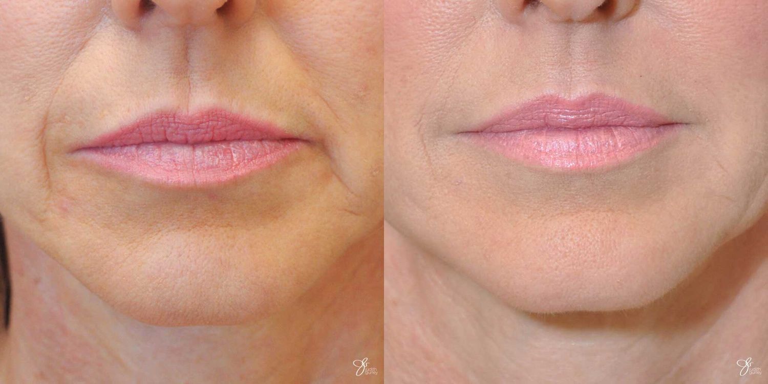 Lip Filler Before & After