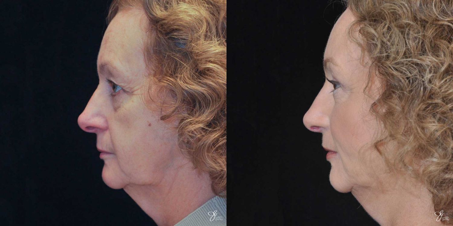 Facial Liposuction Before & After