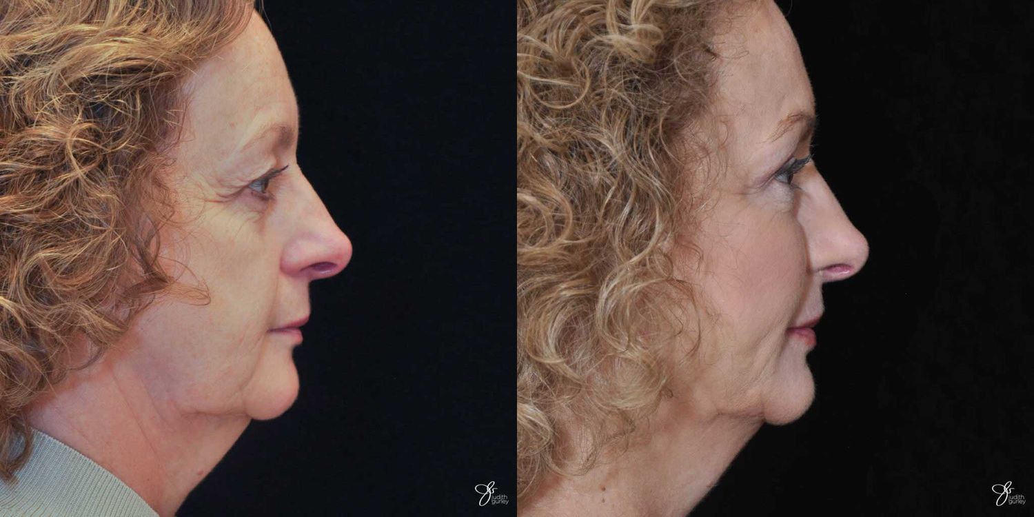 Facial Liposuction Before & After