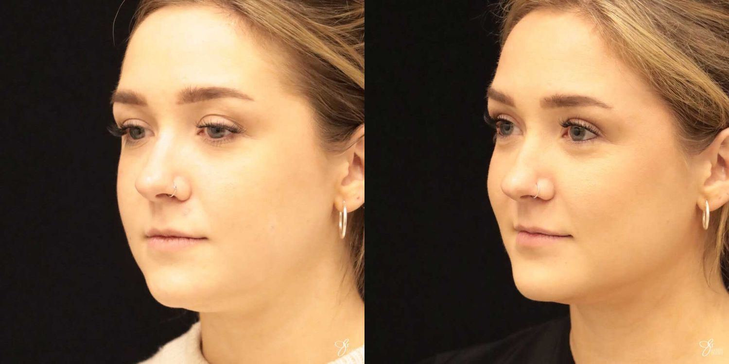 Facial Liposuction Before & After
