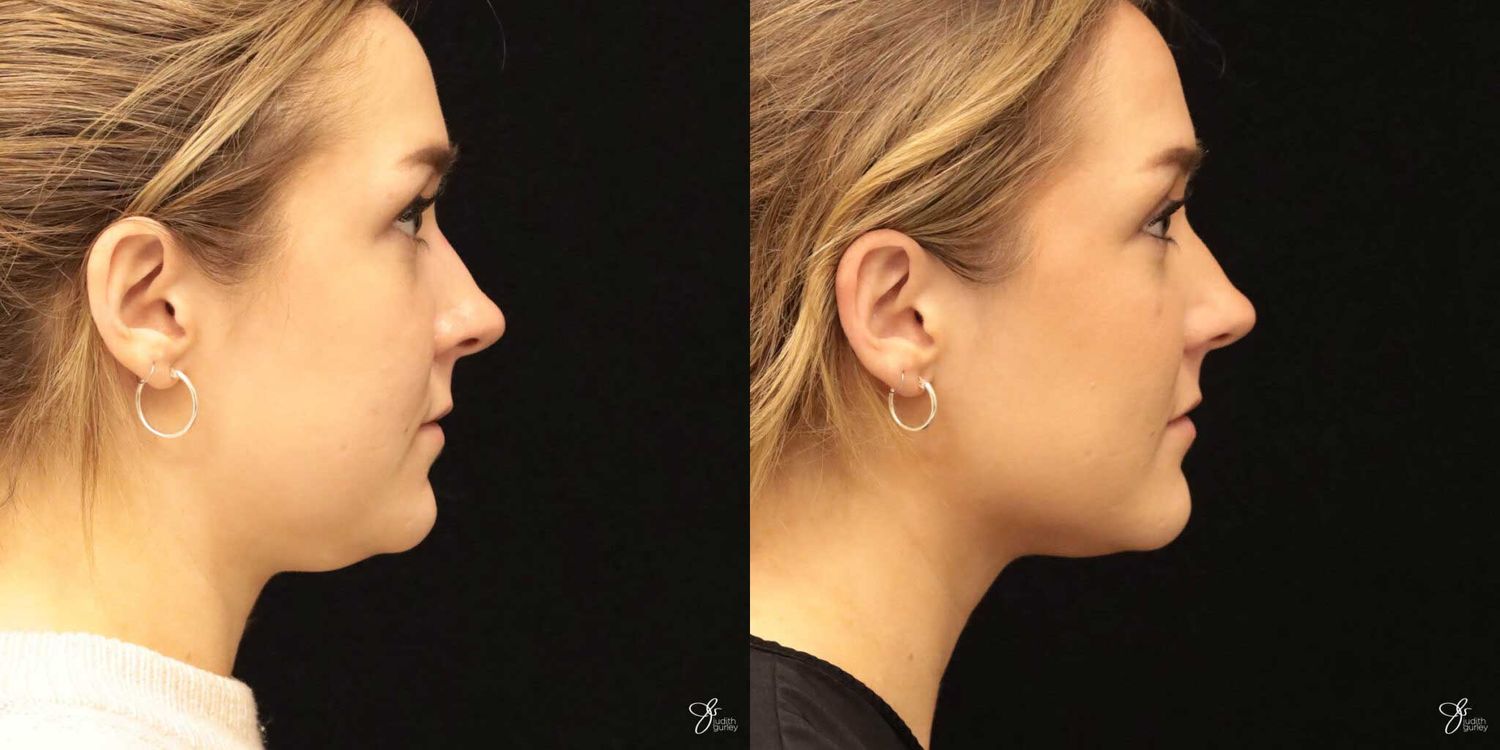 Facial Liposuction Before & After