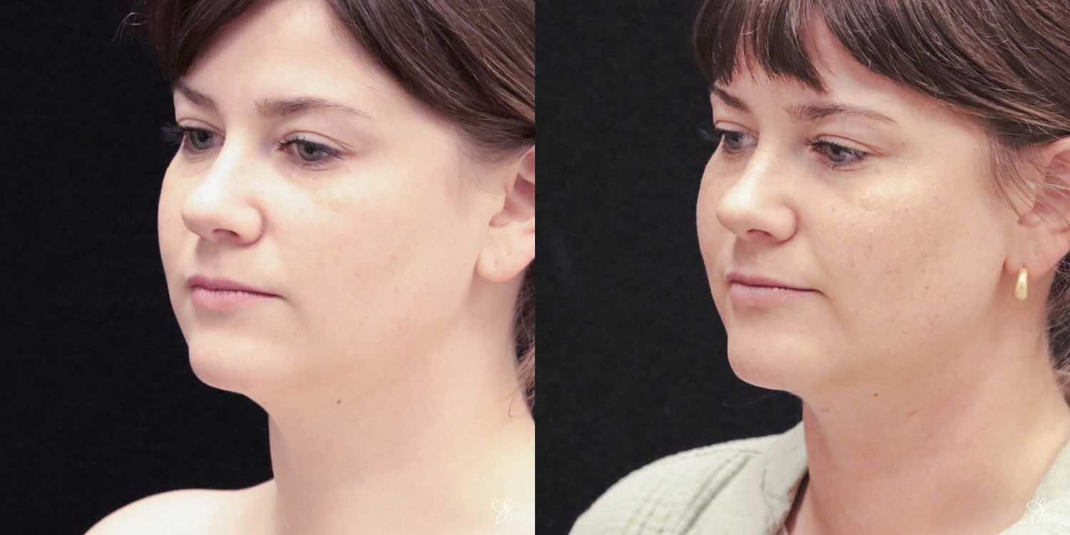 Facial Liposuction Before & After