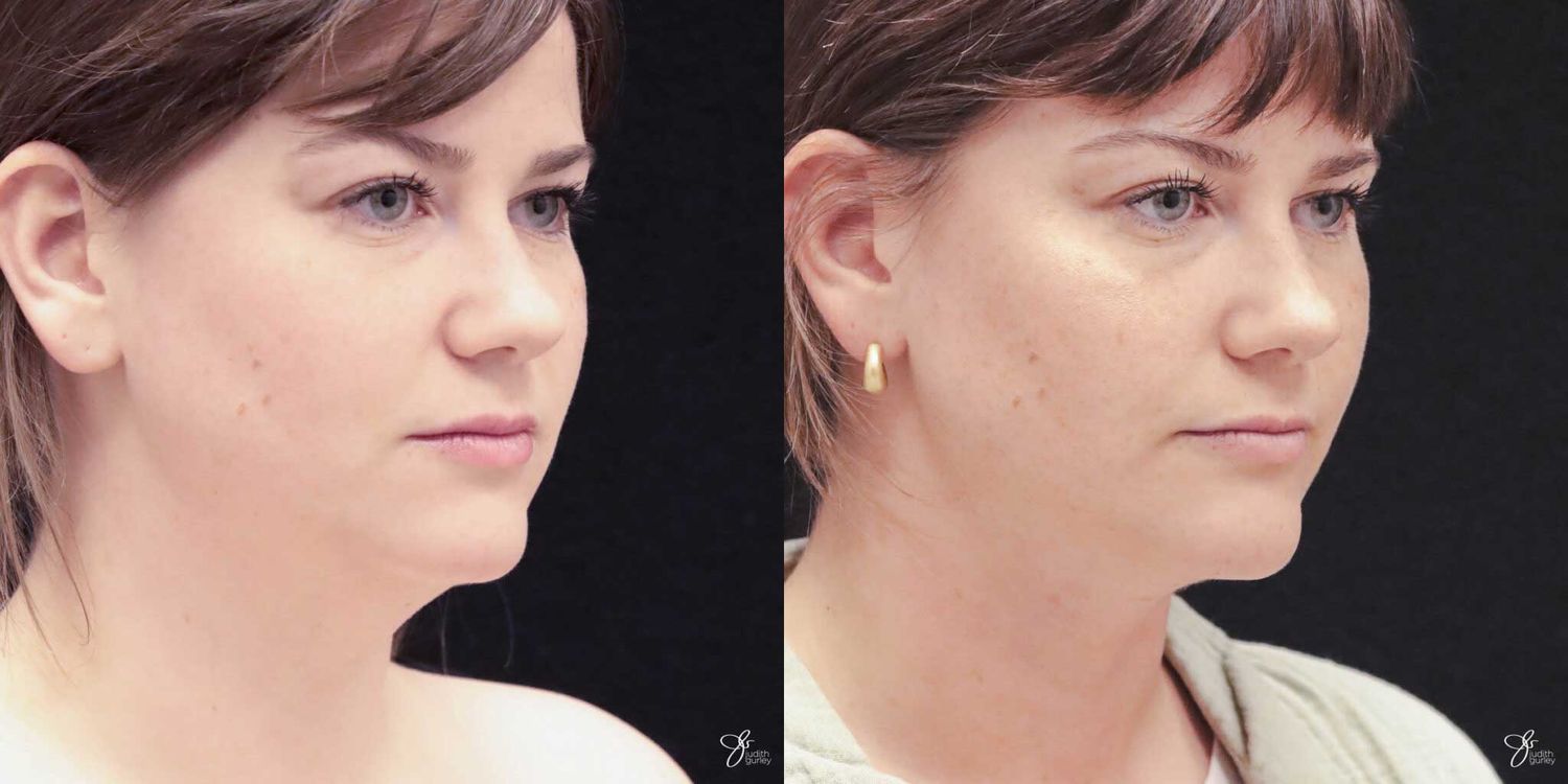 Facial Liposuction Before & After