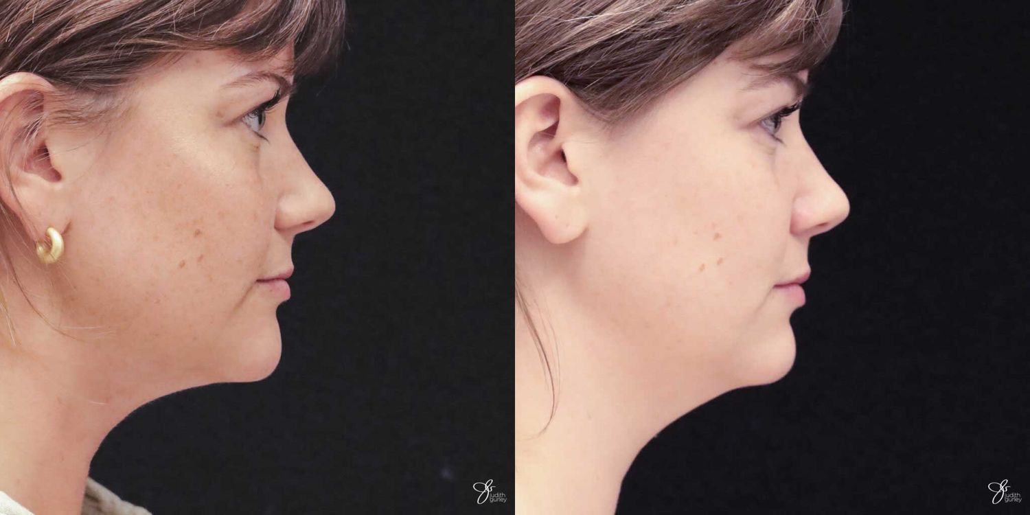 Facial Liposuction Before & After