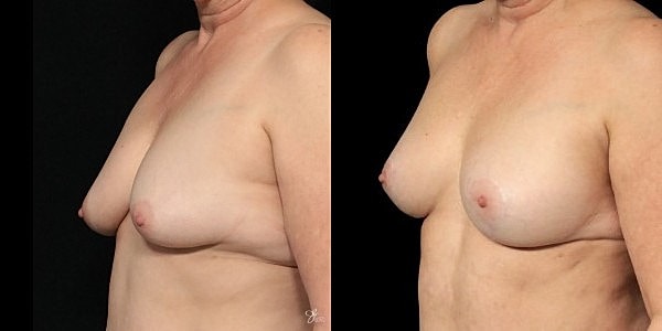 Breast Augmentation And Lift Before & After