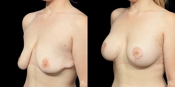 Breast Augmentation And Lift Before & After