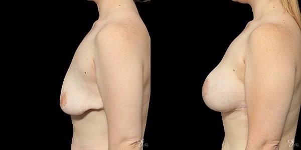 Breast Augmentation And Lift Before & After
