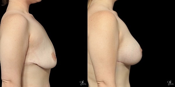 Breast Augmentation And Lift Before & After