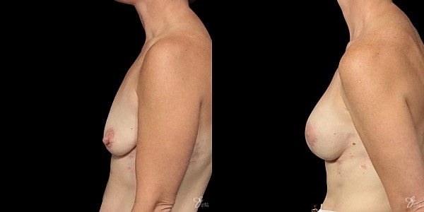 Breast Augmentation And Lift Before & After