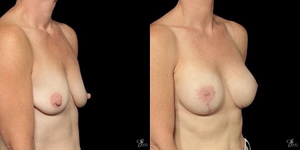 Breast Augmentation And Lift Before & After